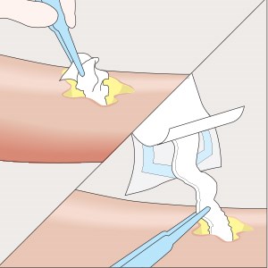 Étape 2 de l'application de Mesalt